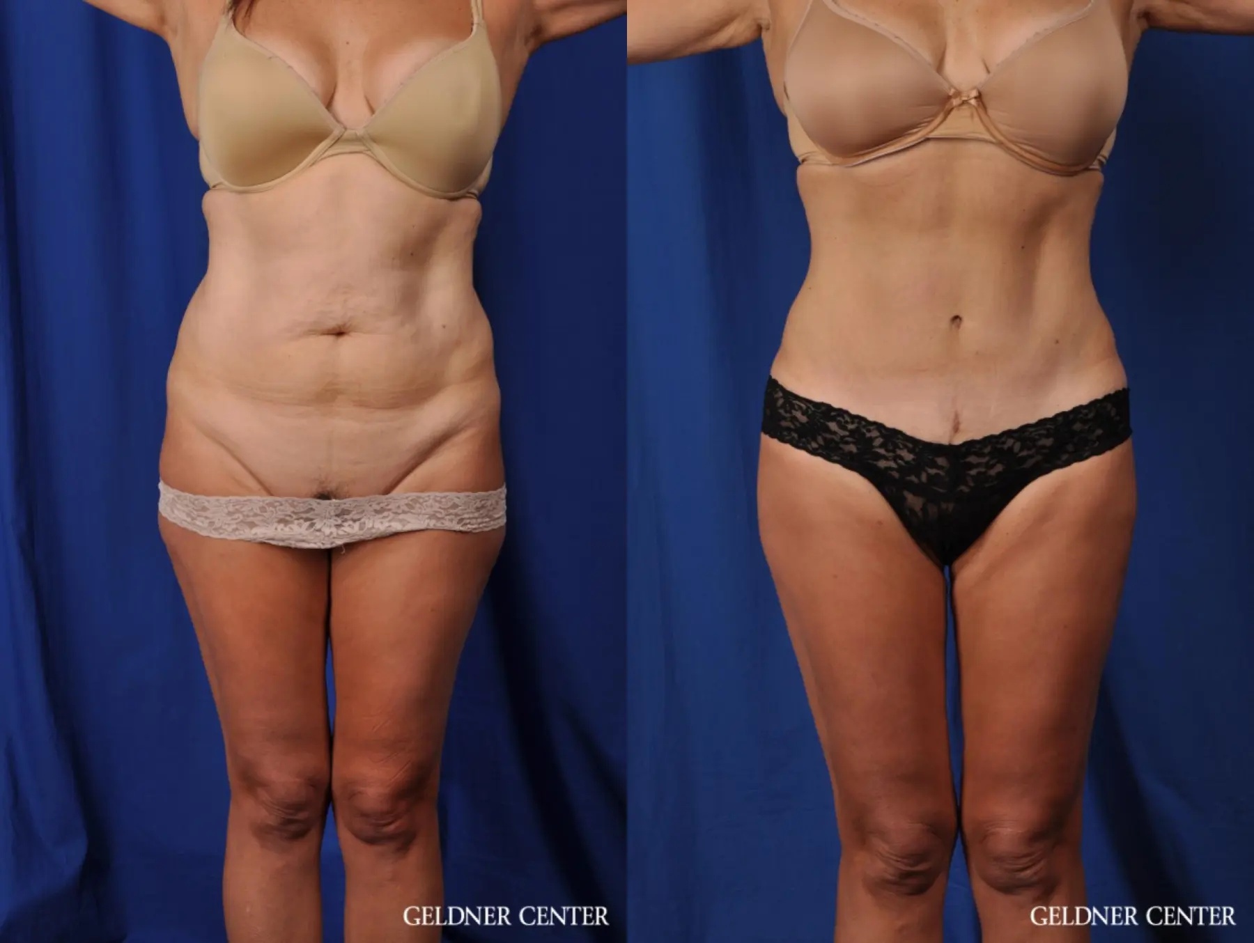 Abdominoplasty with Vaser liposuction of the abdomen, flanks, inner and outer thighs. - Before and After