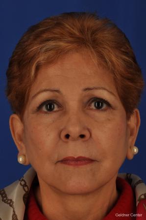 Neck Lift: Patient 1 - After Image 1