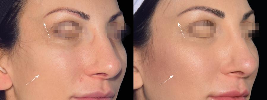 EMFACE™: Patient 3 - Before and After  