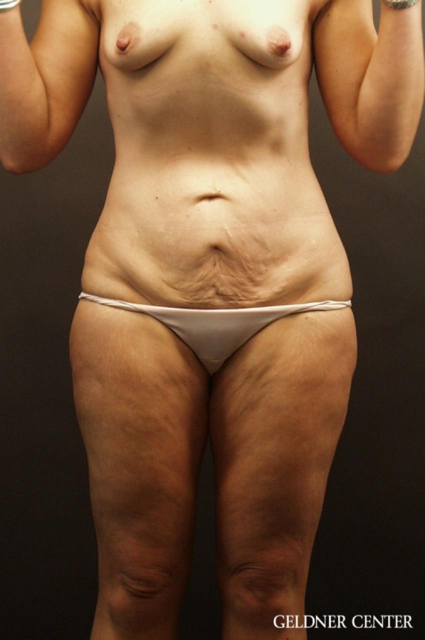 Tummy Tuck: Patient 17 - Before 