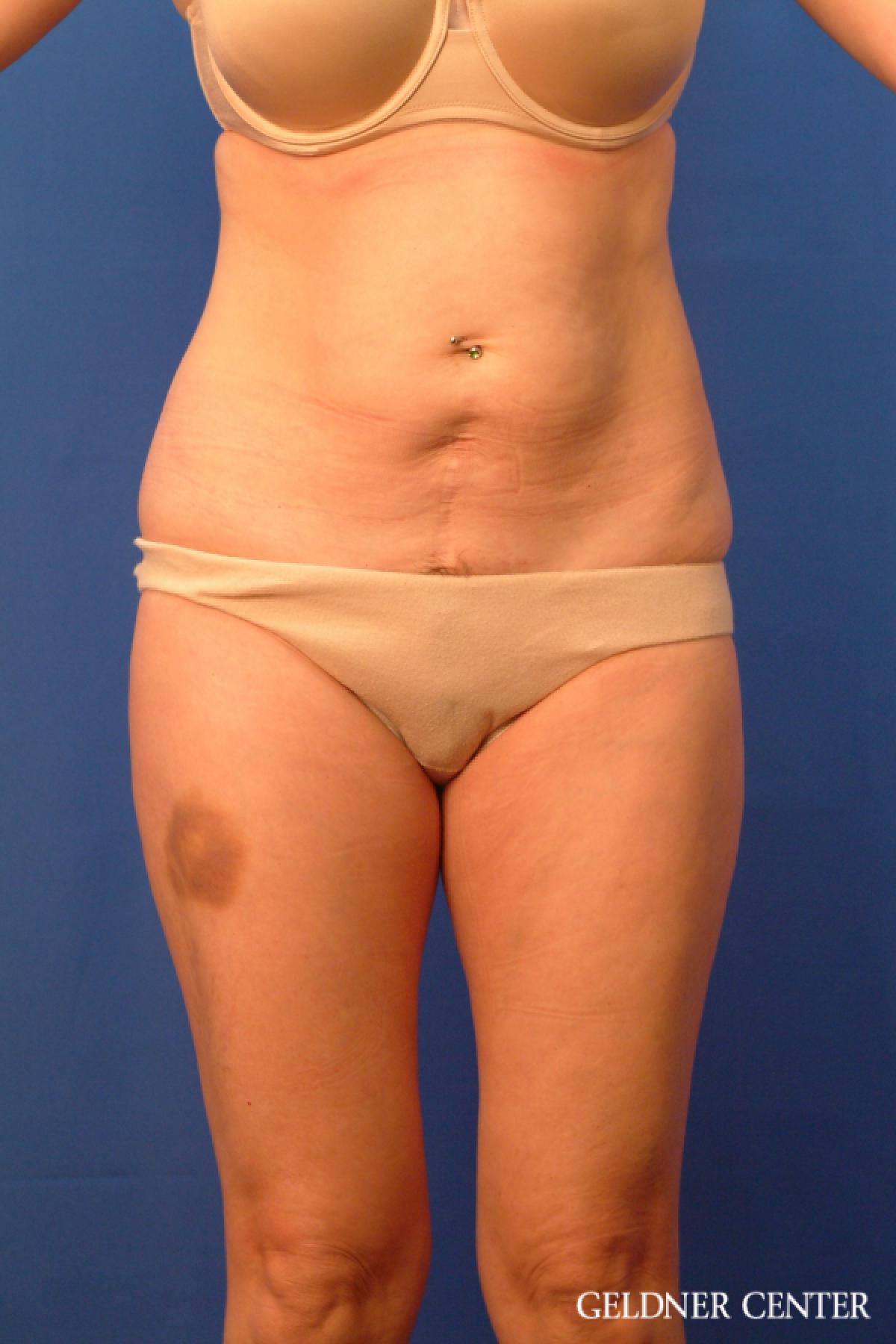 Tummy Tuck: Patient 36 - Before 