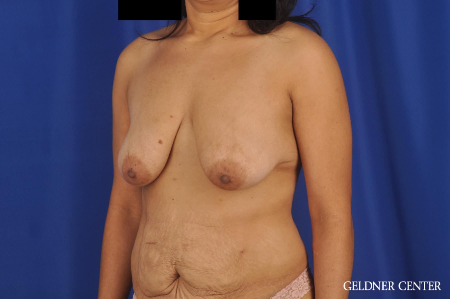 Breast Lift: Patient 49 - Before and After 4