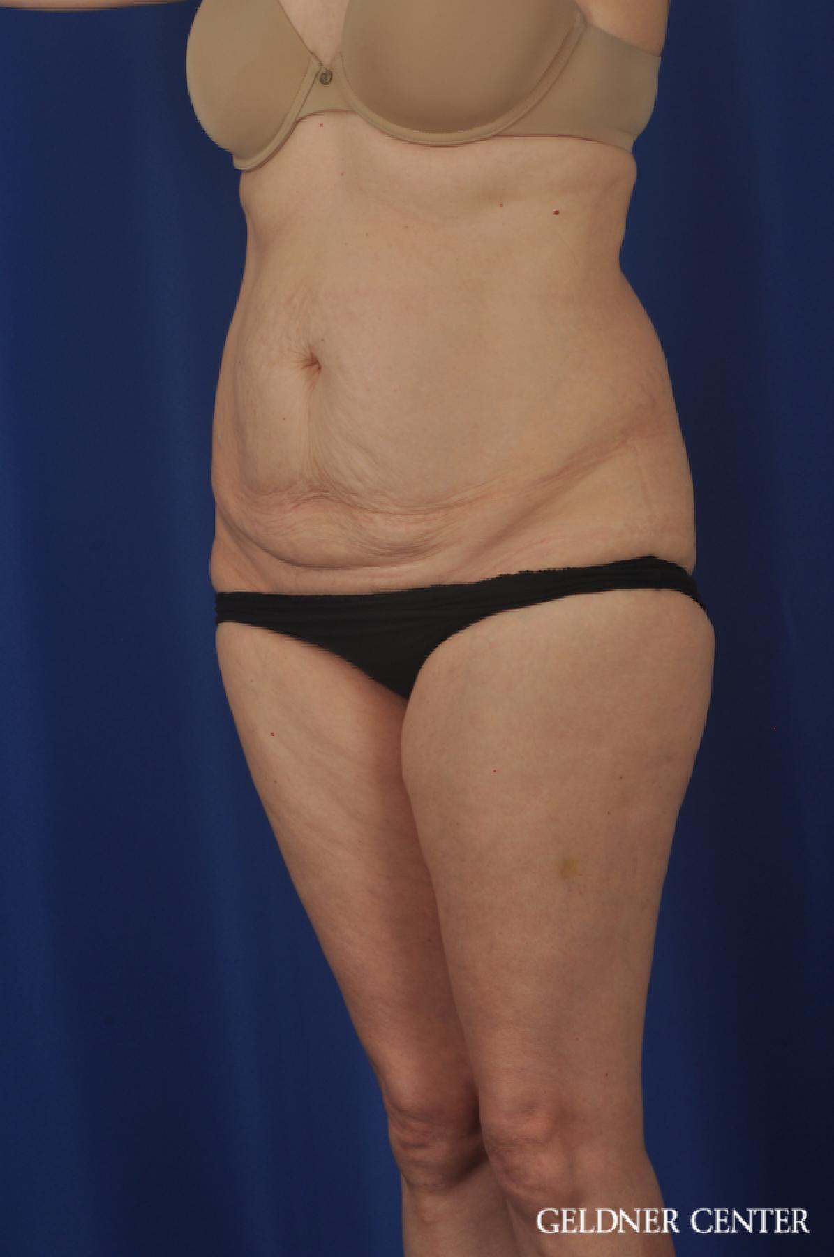 Chicago Abdominoplasty 11851 - Before and After 4