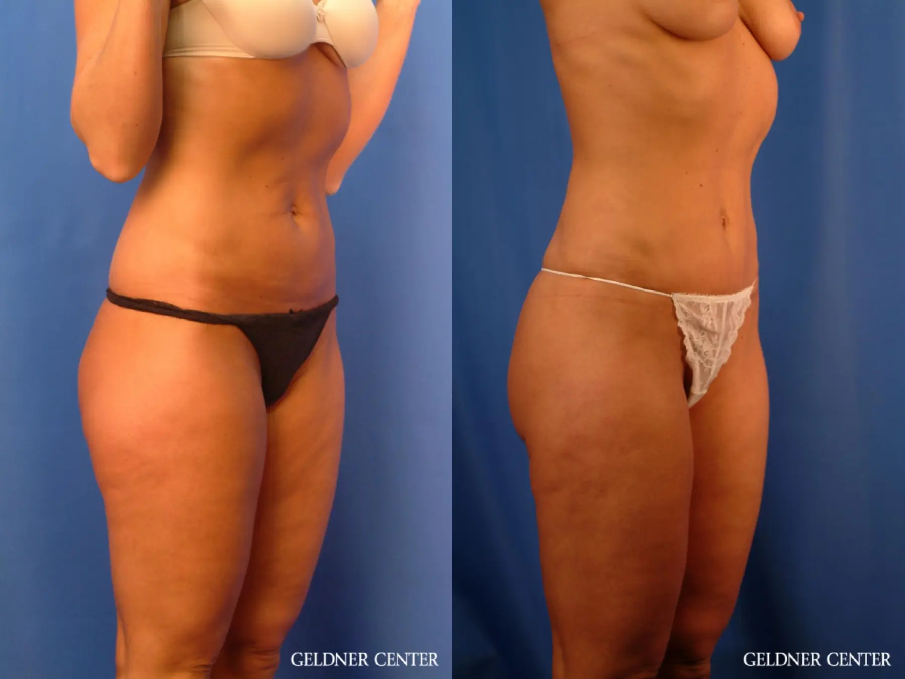 Vaser lipo patient 2624 before and after photos - Before and After 2