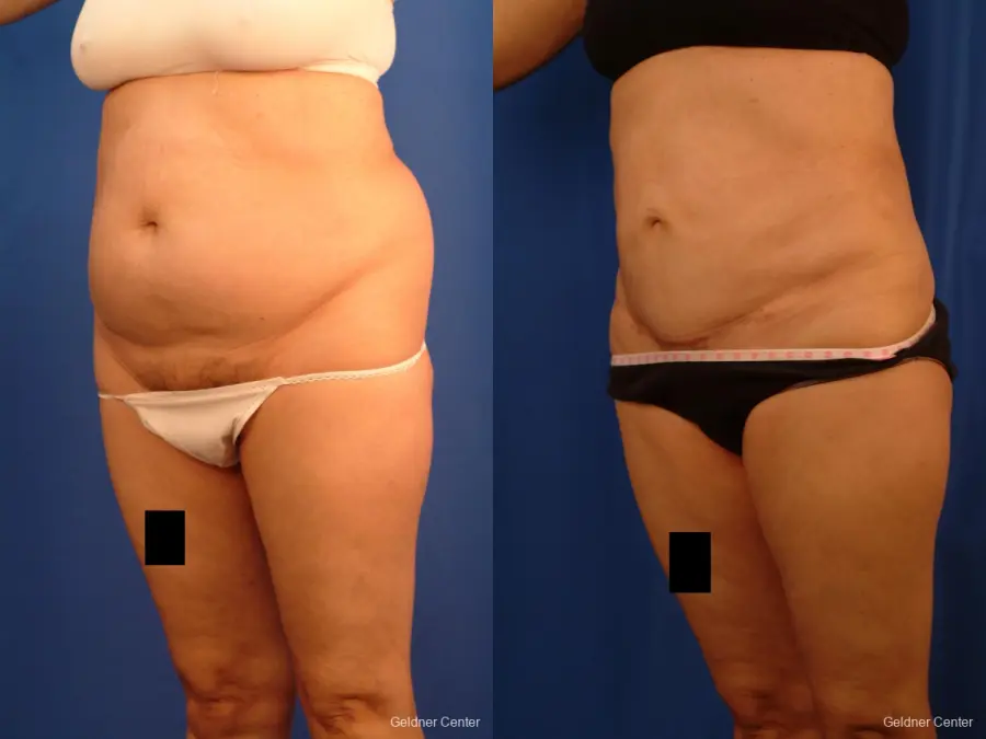 Vaser lipo patient 2536 before and after photos - Before and After 4