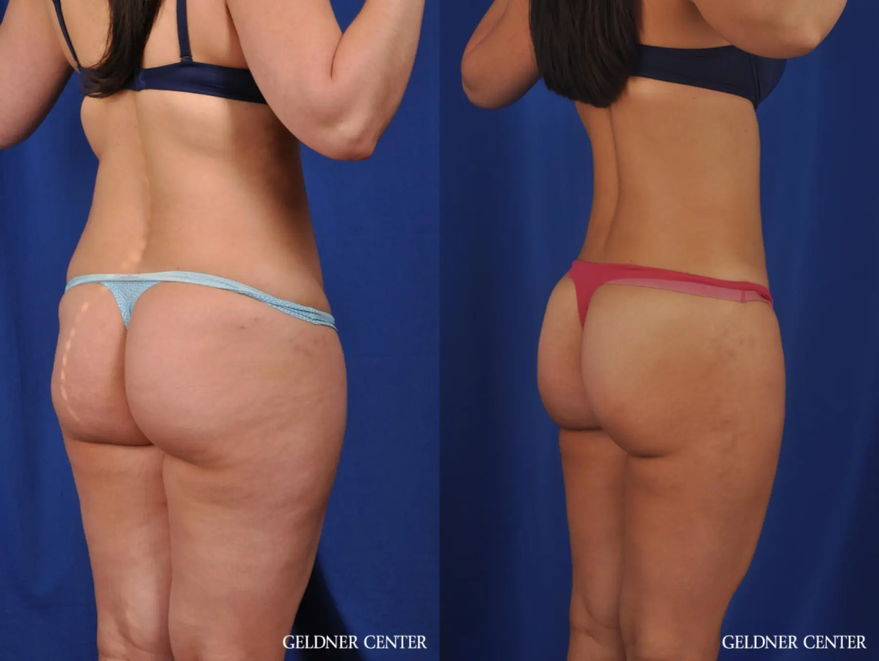 VASER® Lipo: Patient 9 - Before and After 4