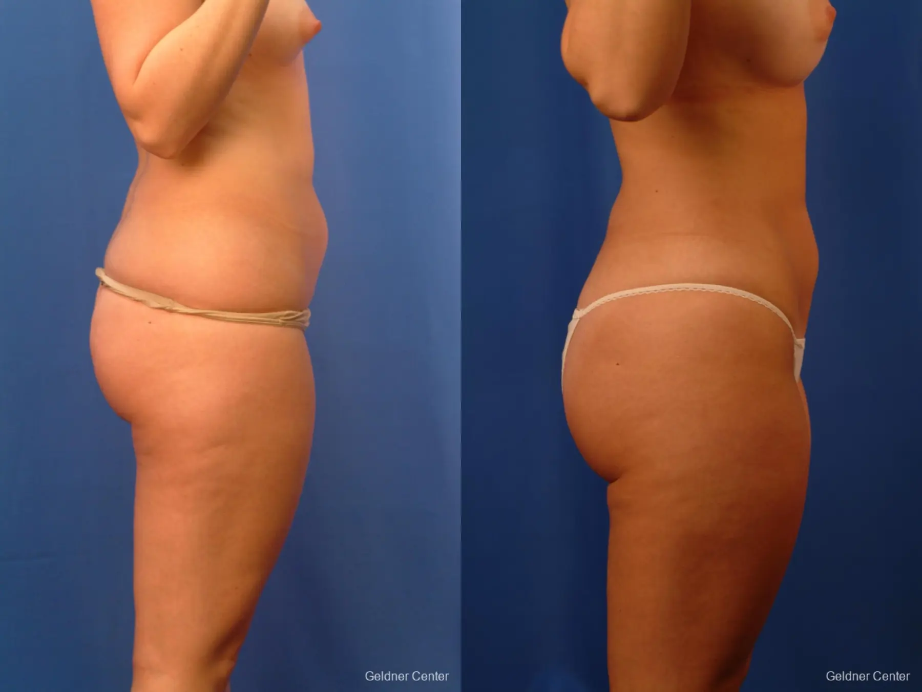 Vaser lipo patient 2516 before and after photos - Before and After 3