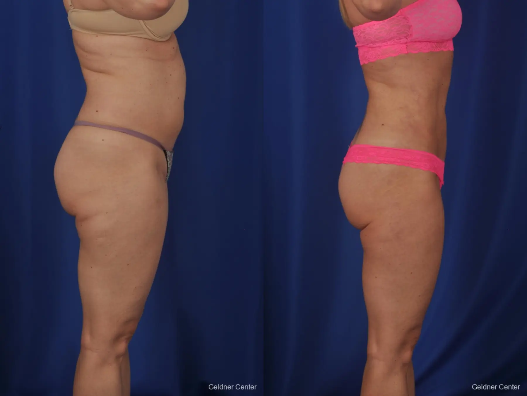Vaser lipo patient 2069 before and after photos - Before and After 2