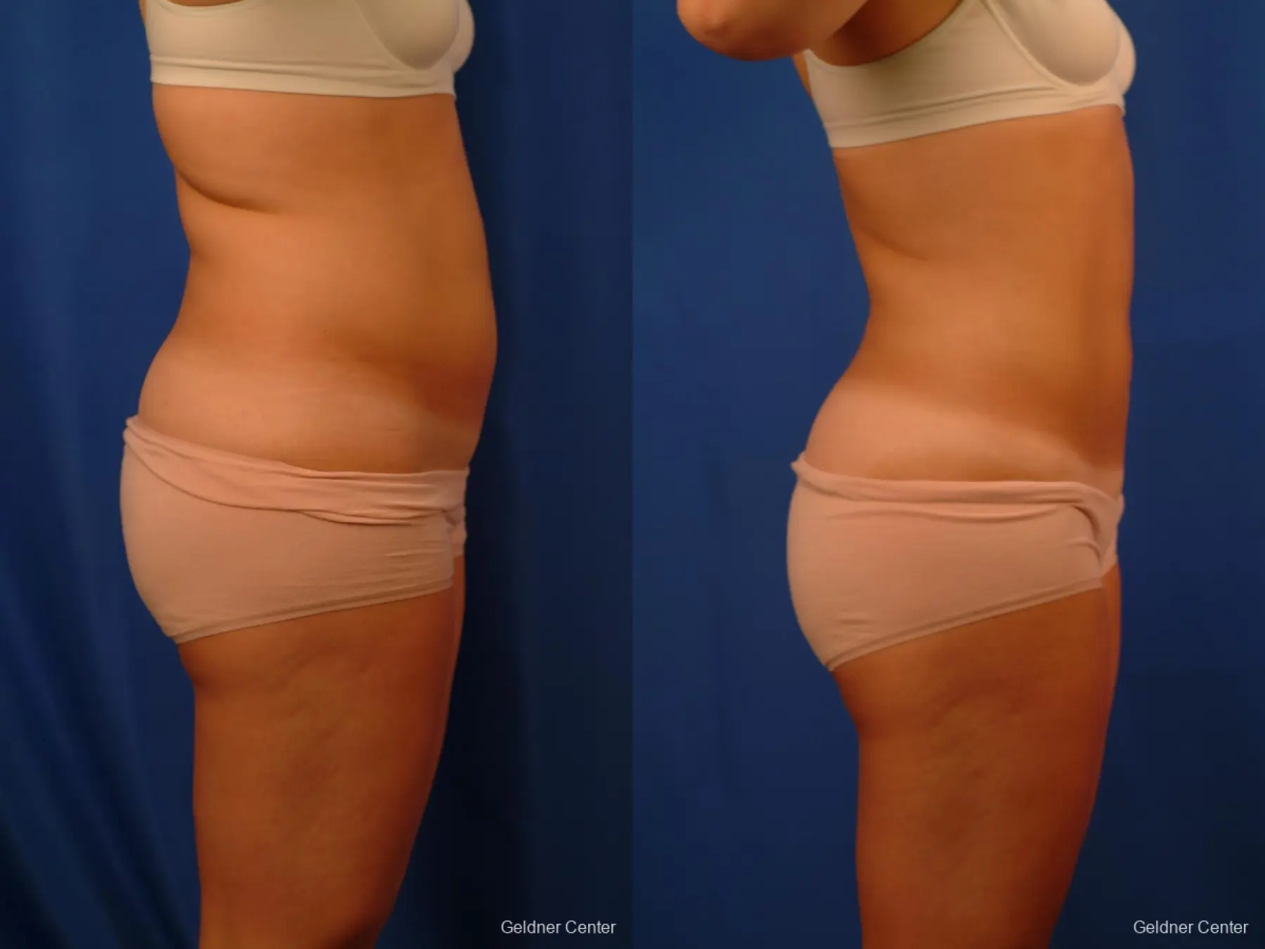 Vaser lipo patient 2514 before and after photos - Before and After 3