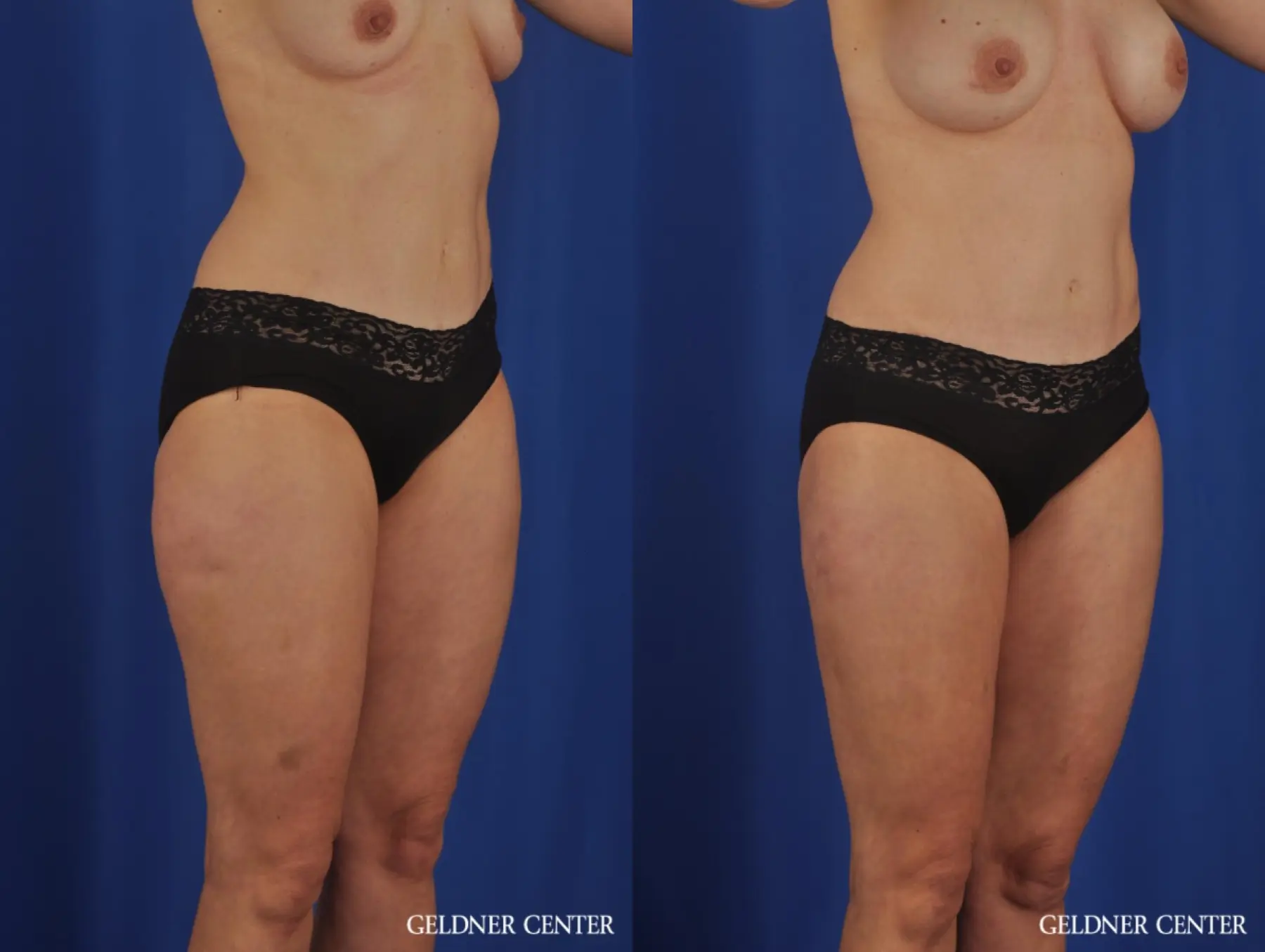 VASER® Lipo: Patient 11 - Before and After 4