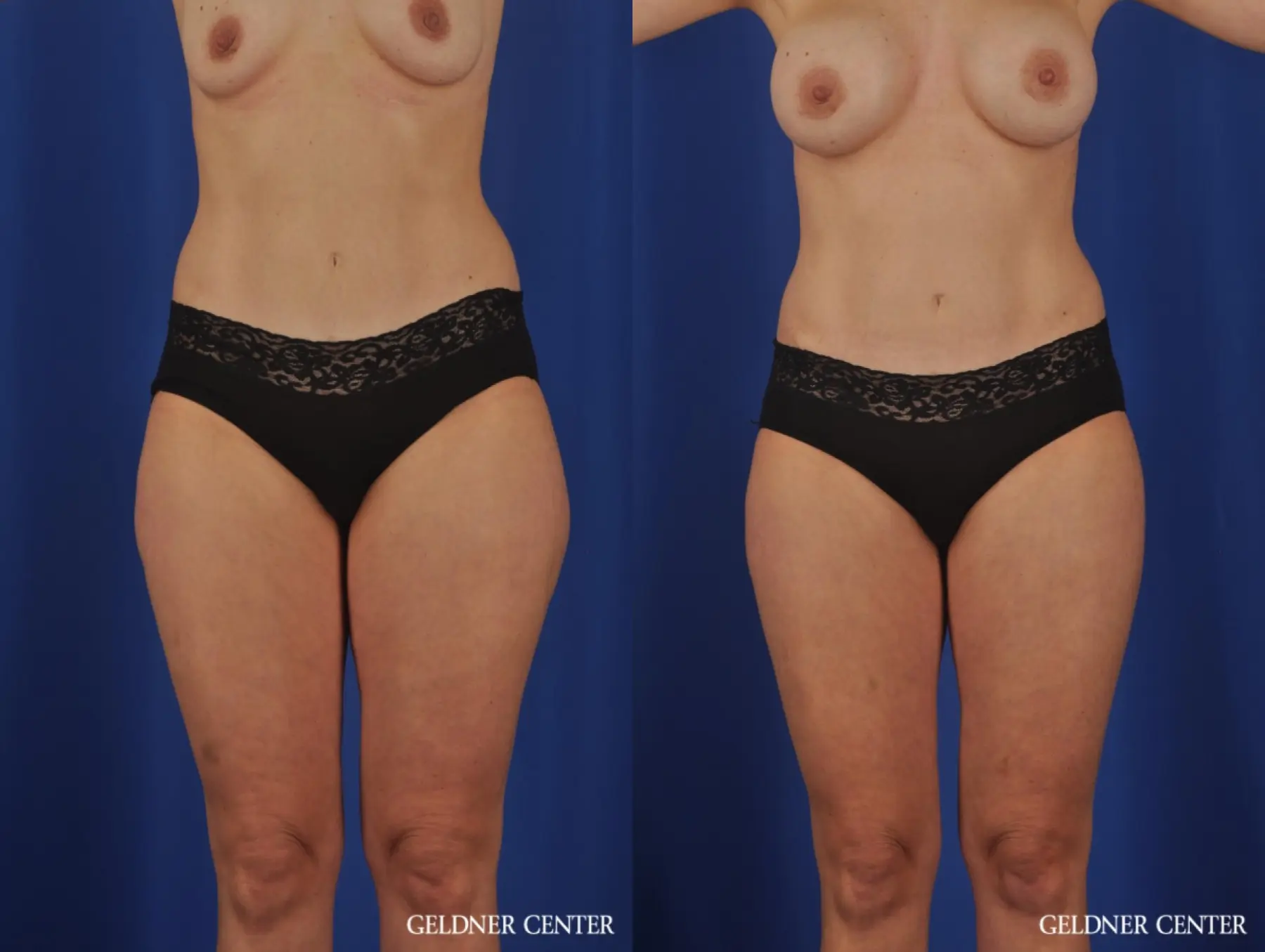 VASER® Lipo: Patient 11 - Before and After 1