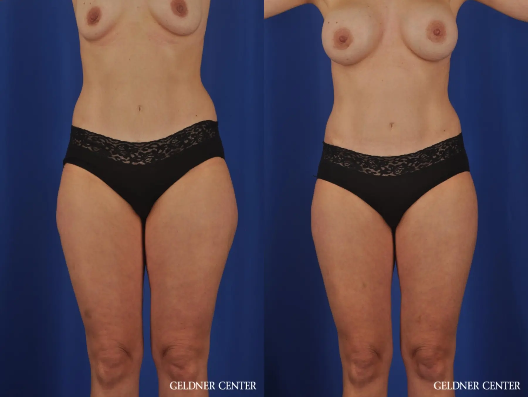 VASER® Lipo: Patient 11 - Before and After  