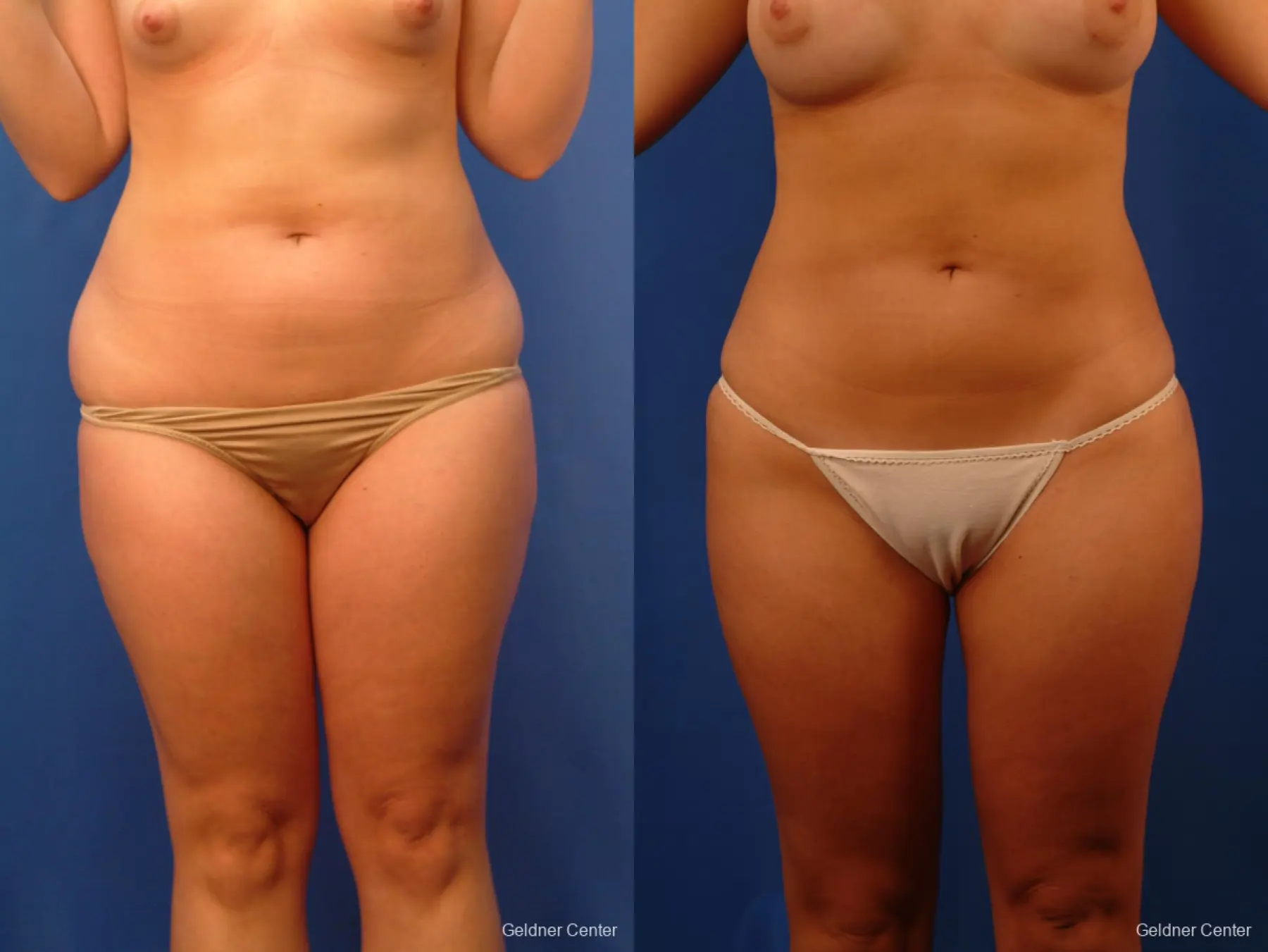 Vaser lipo patient 2516 before and after photos - Before and After