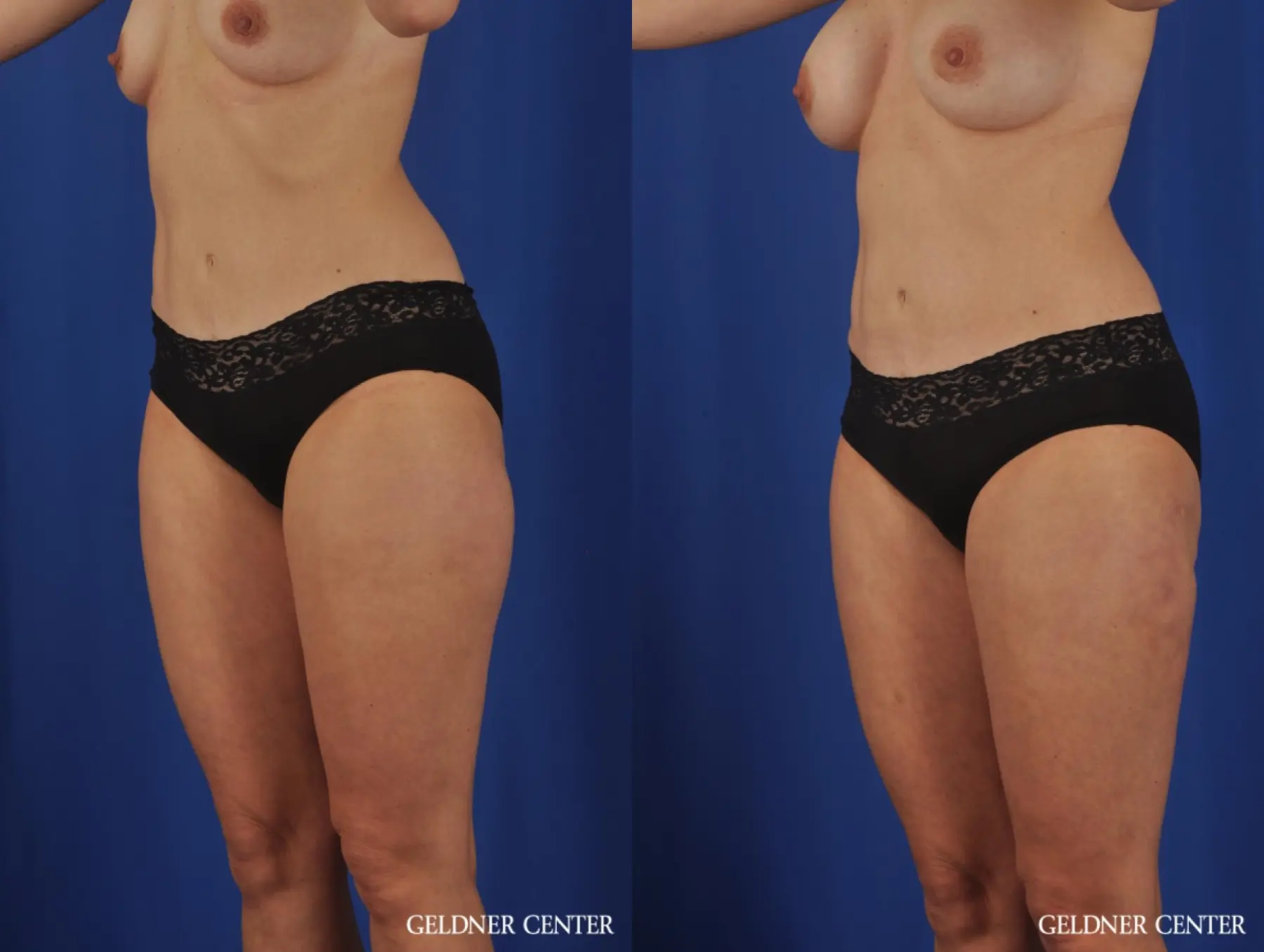 VASER® Lipo: Patient 11 - Before and After 3