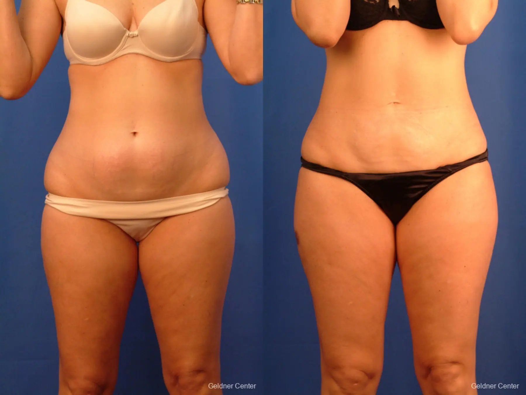 Vaser lipo patient 2520 before and after photos - Before and After
