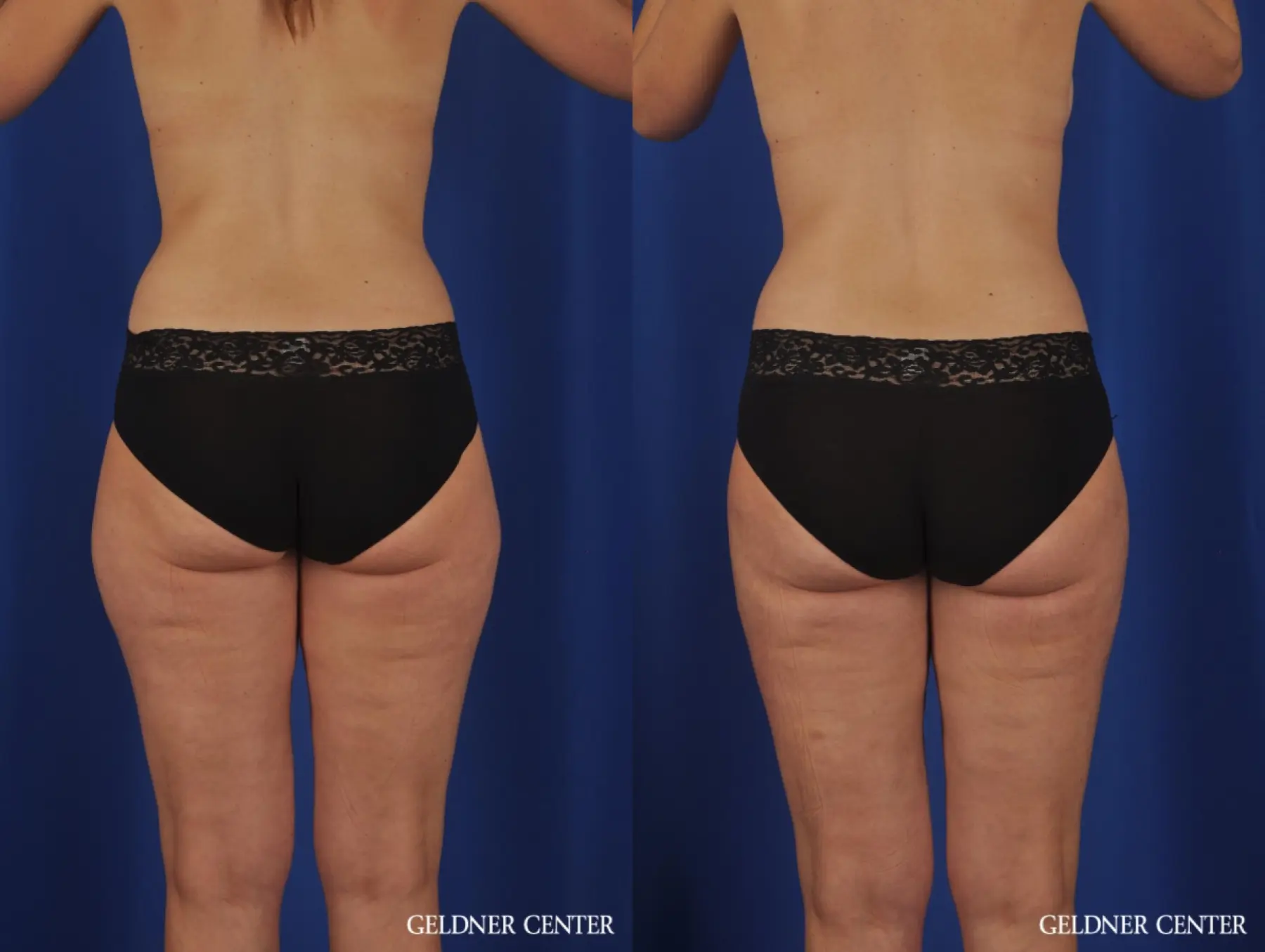 VASER® Lipo: Patient 11 - Before and After 2