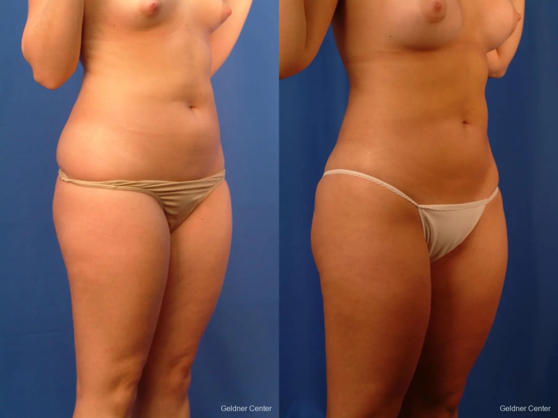 Vaser lipo patient 2516 before and after photos - Before and After 2