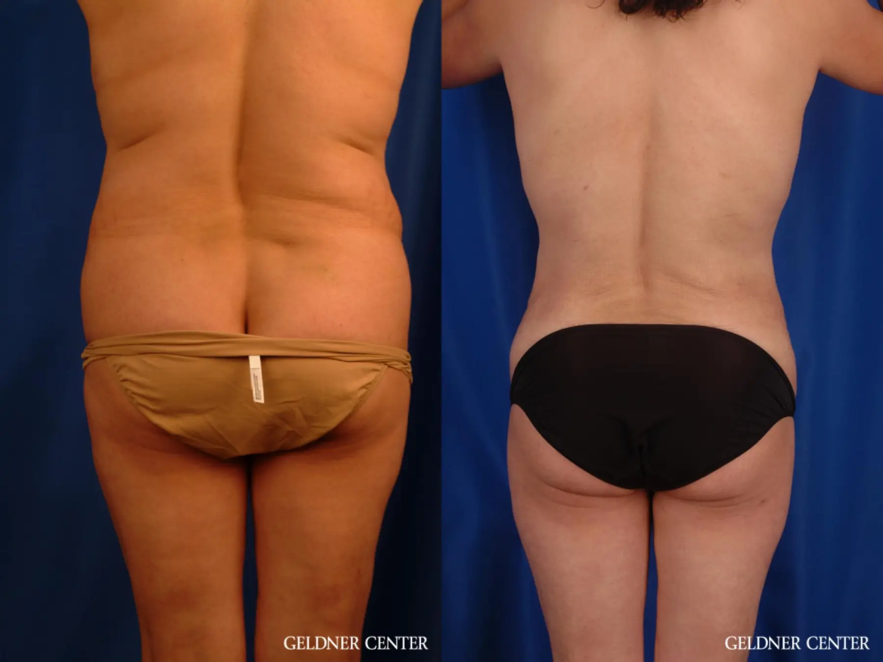 Vaser lipo patient 2629 before and after photos - Before and After 4
