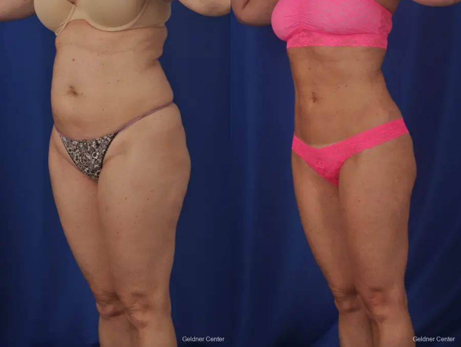 Vaser lipo patient 2069 before and after photos - Before and After 4