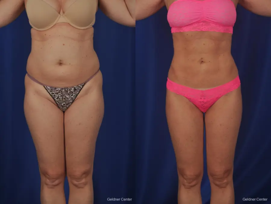 Vaser lipo patient 2069 before and after photos - Before and After 1