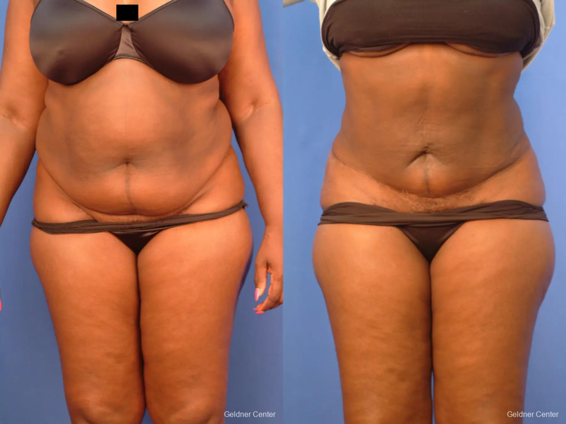 Vaser lipo patient 2540 before and after photos - Before and After 1