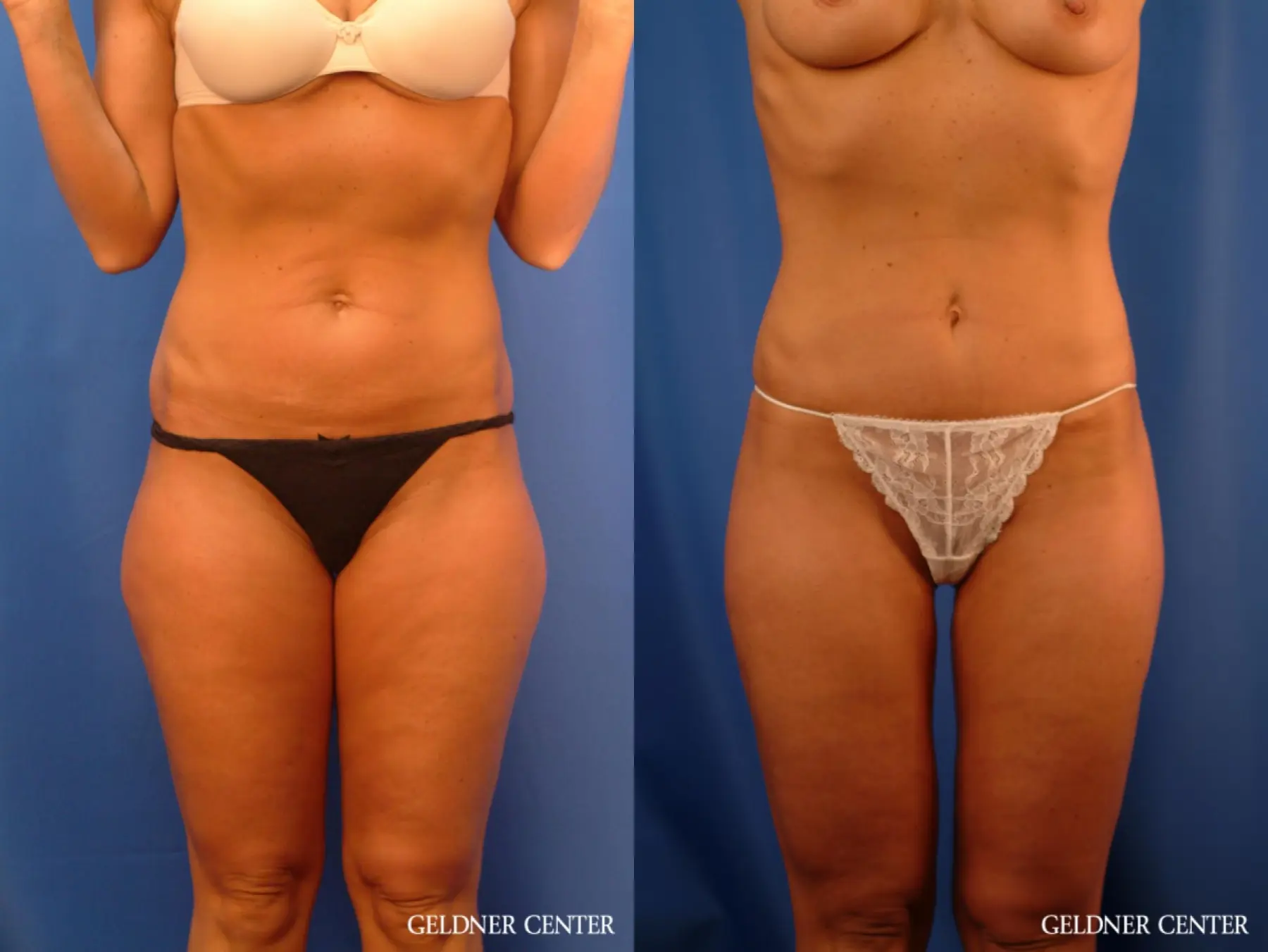 Vaser lipo patient 2624 before and after photos - Before and After