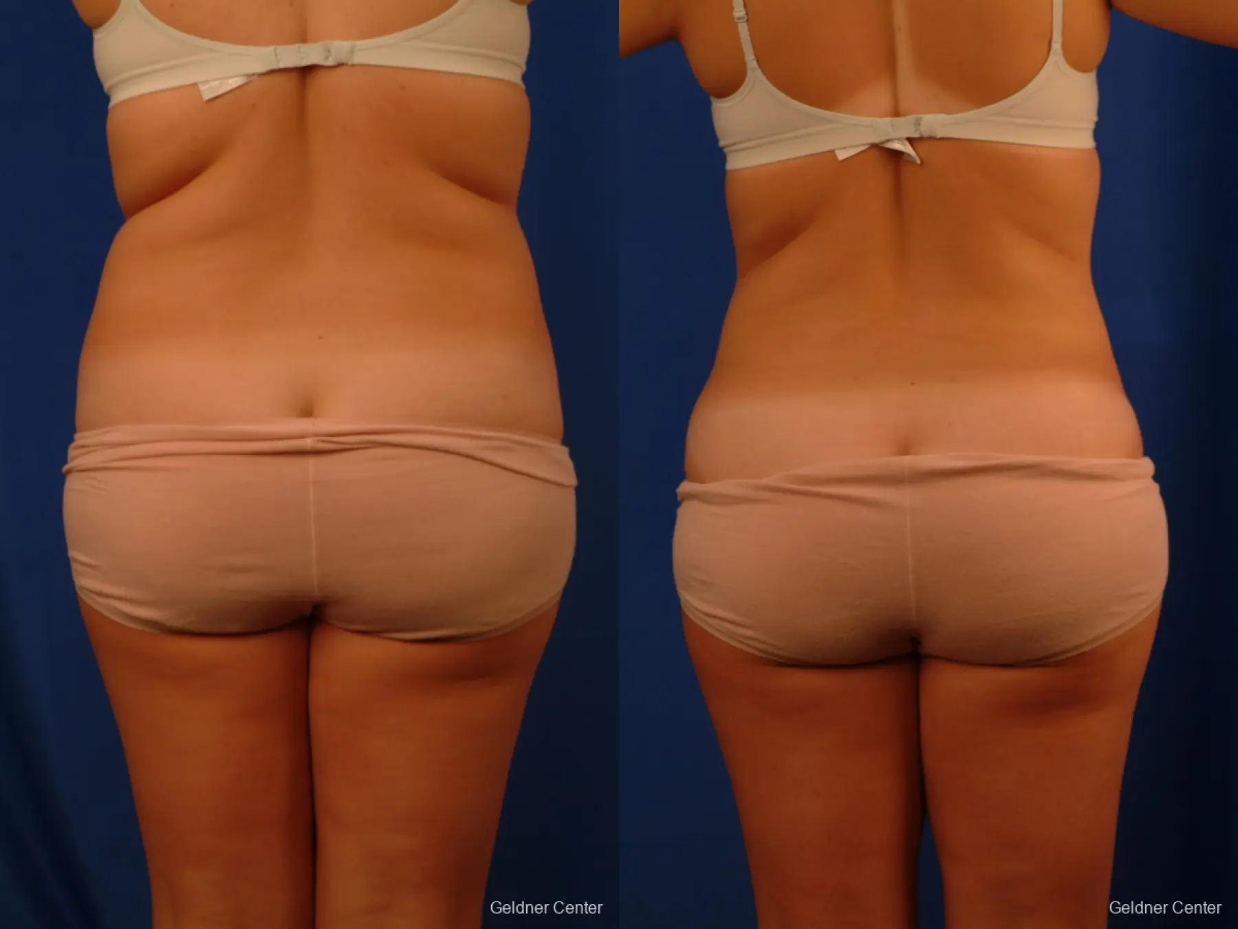 Vaser lipo patient 2514 before and after photos - Before and After 4