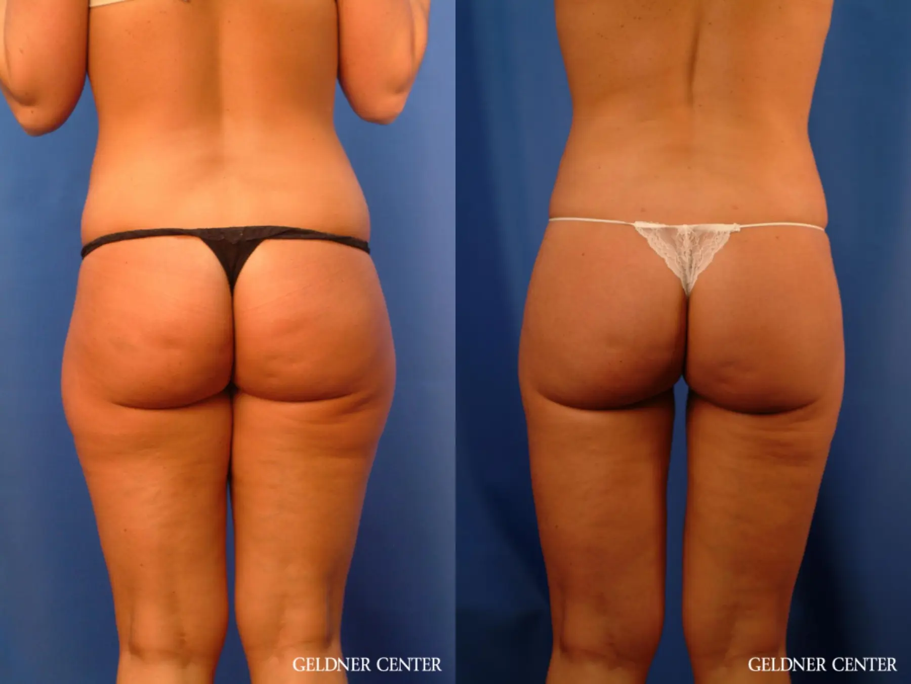 Vaser lipo patient 2624 before and after photos - Before and After 4