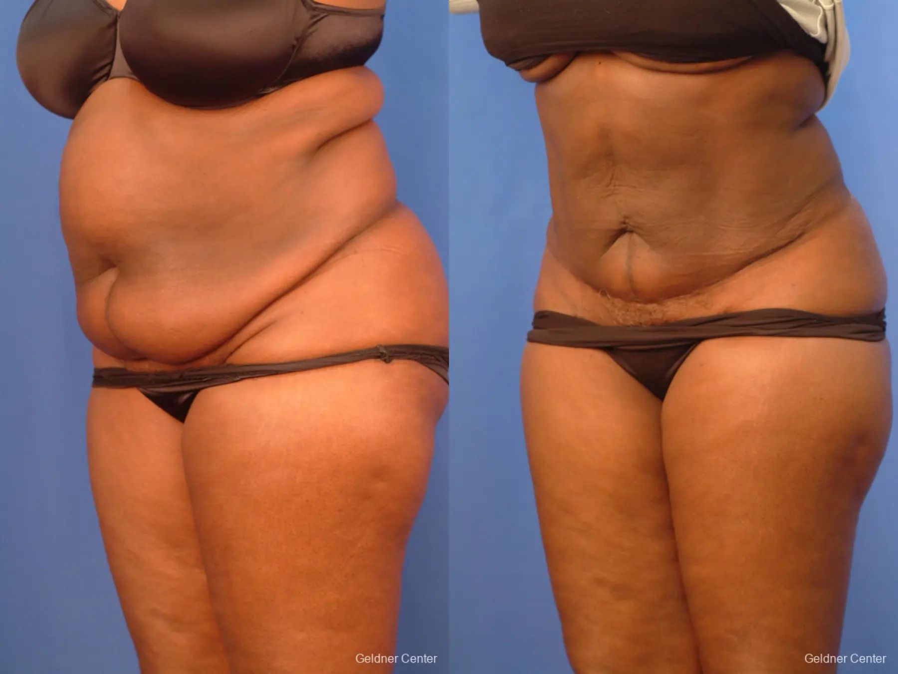 Vaser lipo patient 2540 before and after photos - Before and After 5
