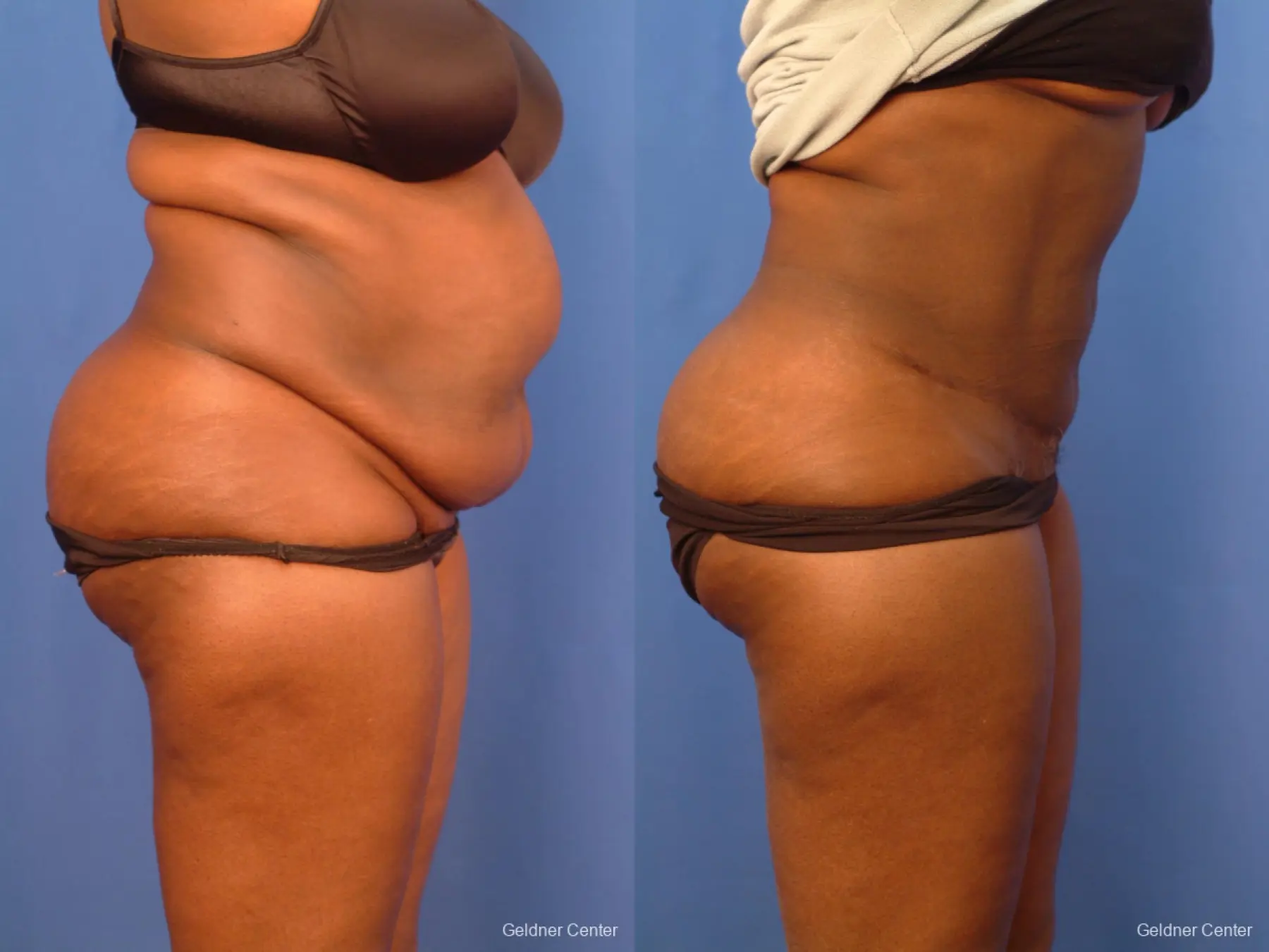 Vaser lipo patient 2540 before and after photos - Before and After 2