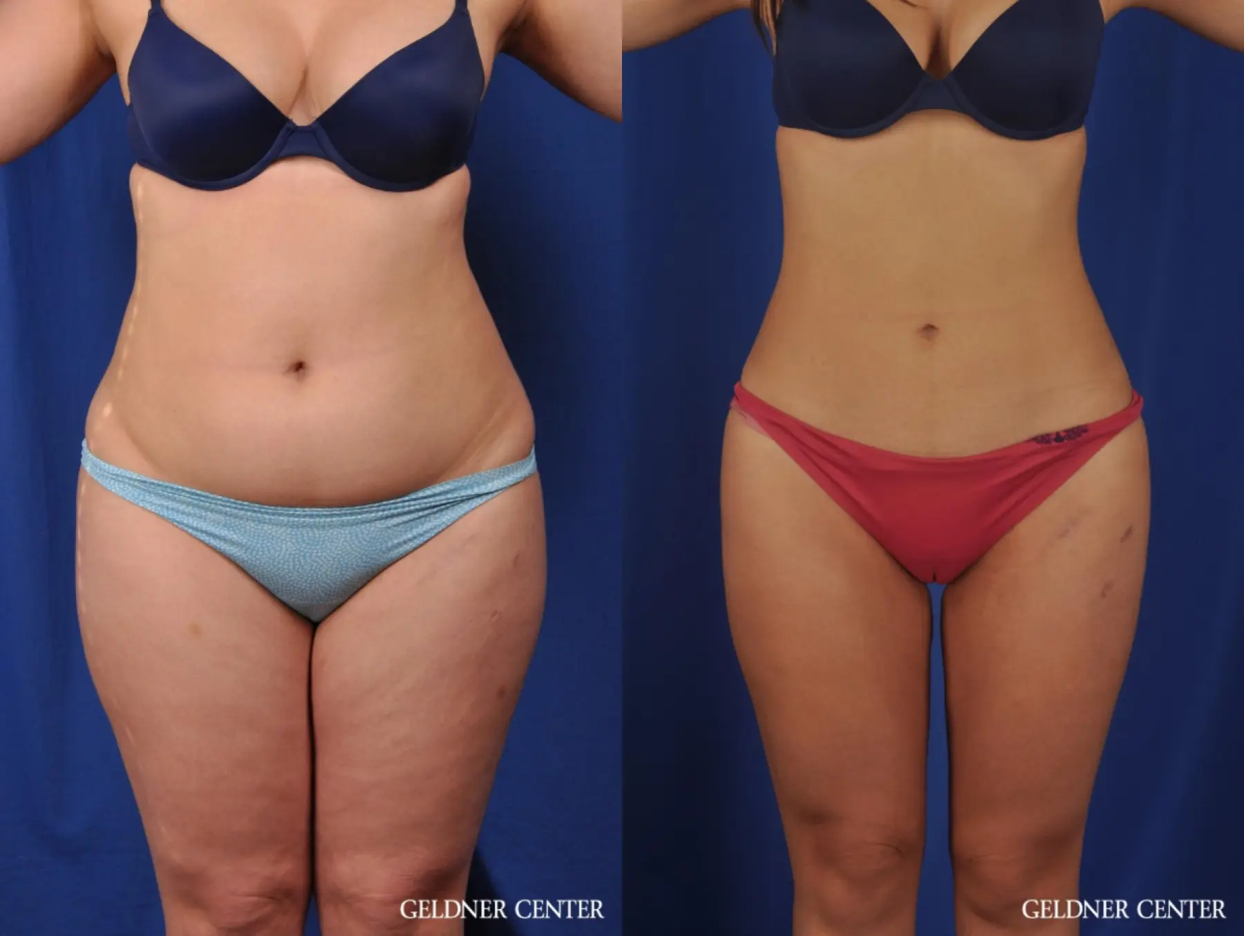 VASER® Lipo: Patient 9 - Before and After 1