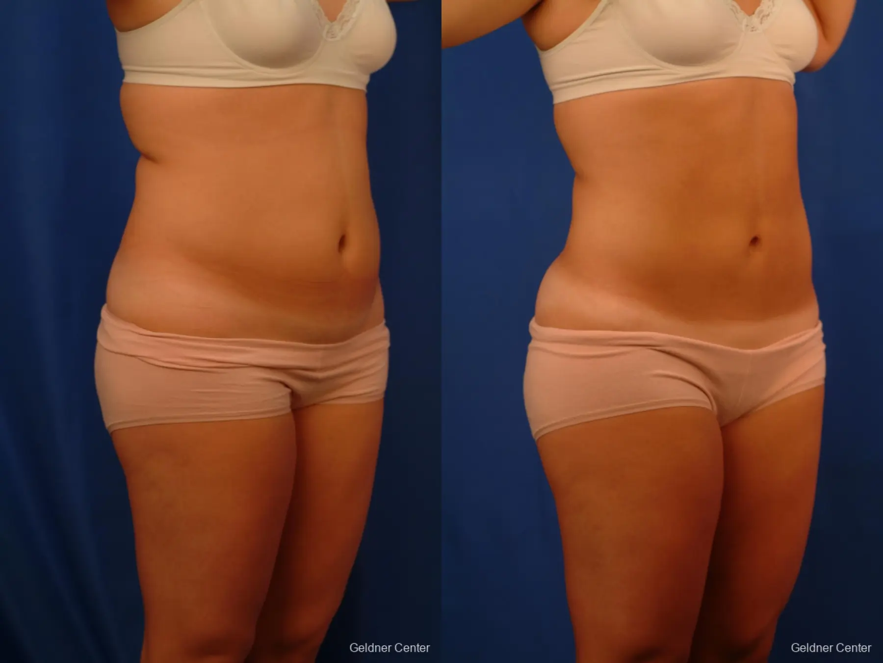 Vaser lipo patient 2514 before and after photos - Before and After 2