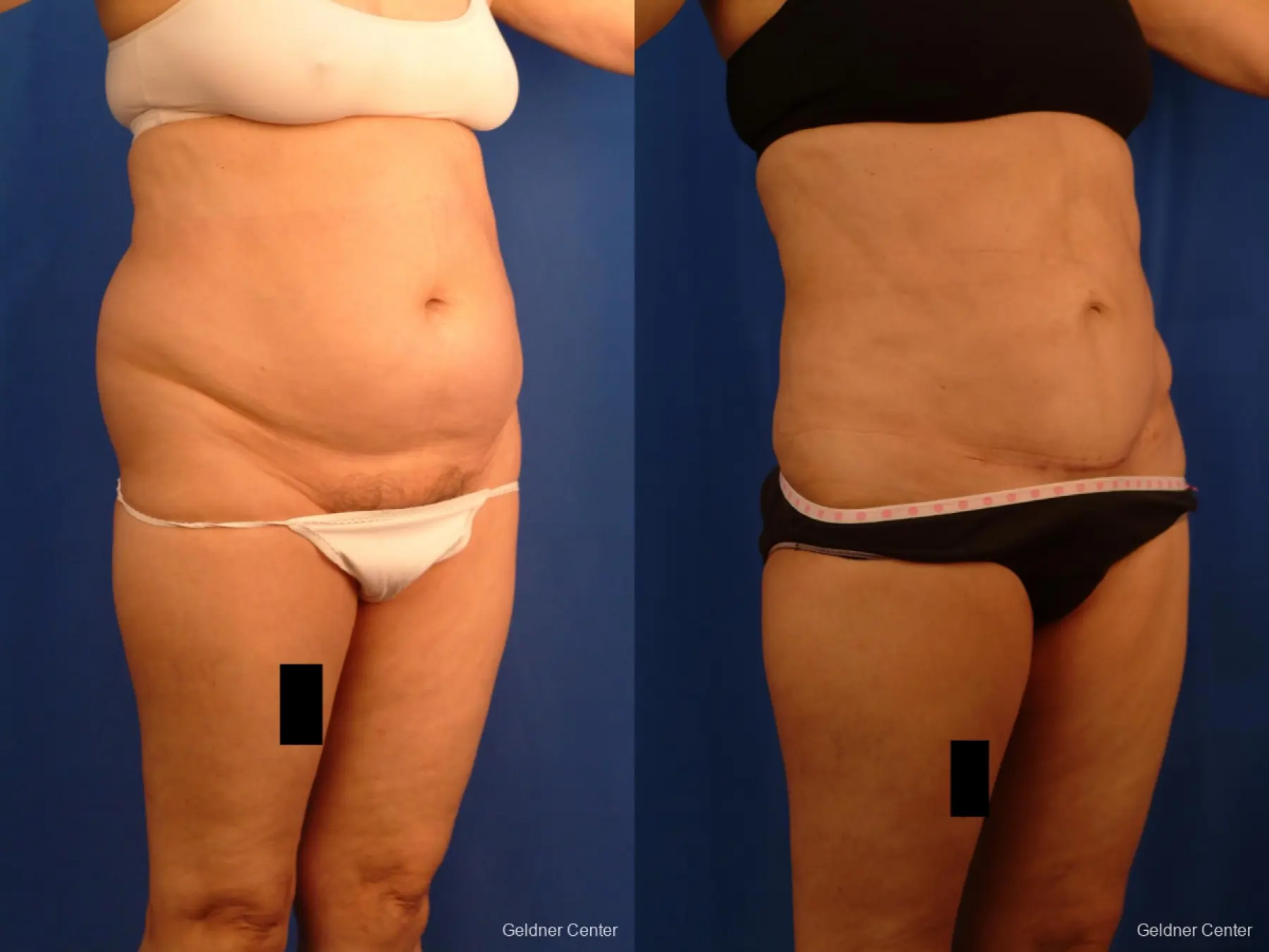 Vaser lipo patient 2536 before and after photos - Before and After 3