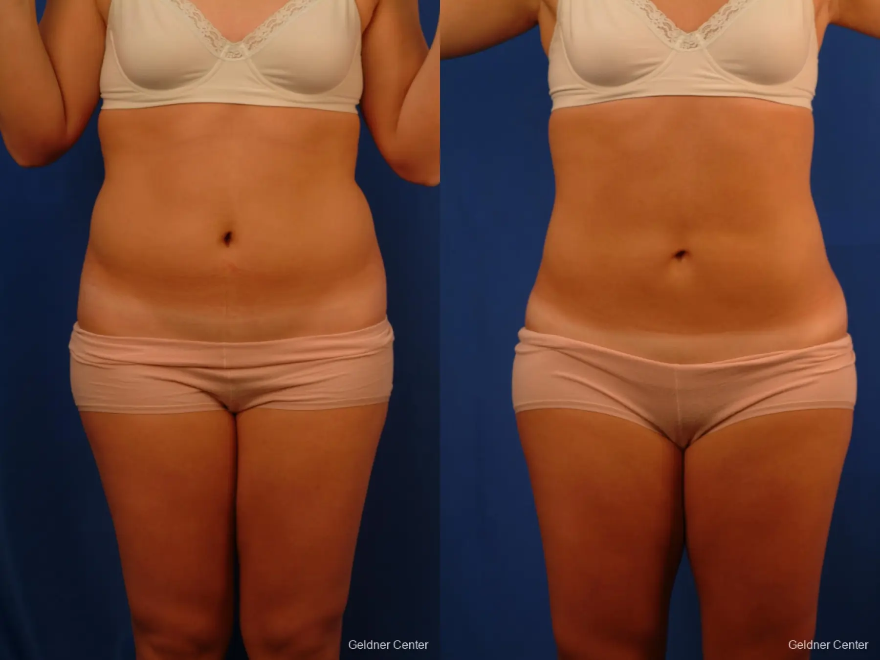 Vaser lipo patient 2514 before and after photos - Before and After
