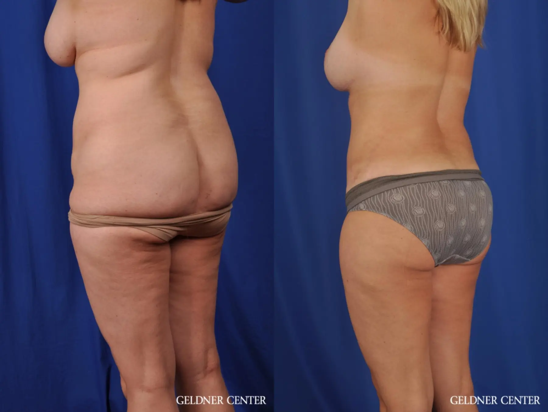 VASER® Lipo: Patient 12 - Before and After 5