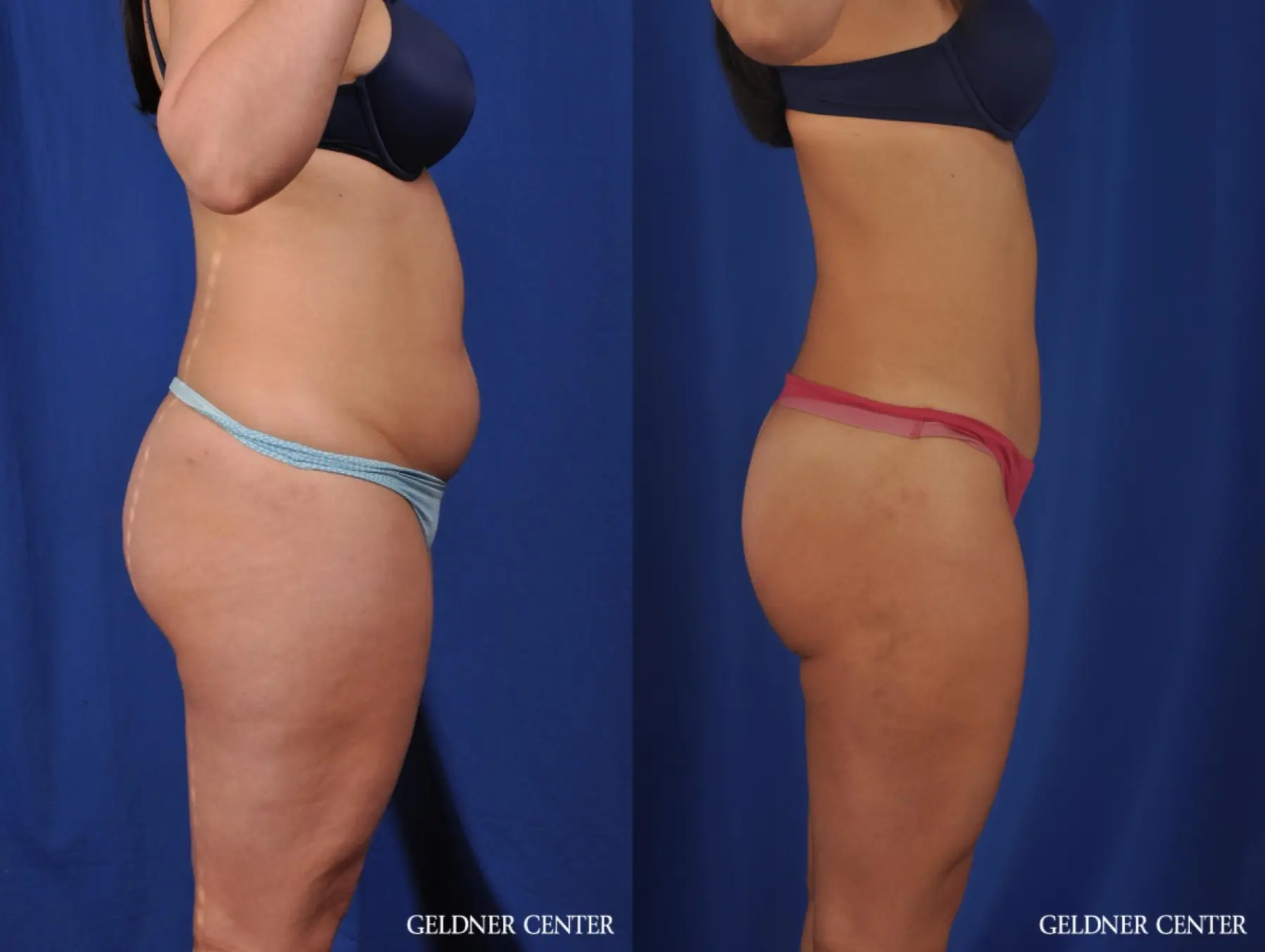 VASER® Lipo: Patient 9 - Before and After 3