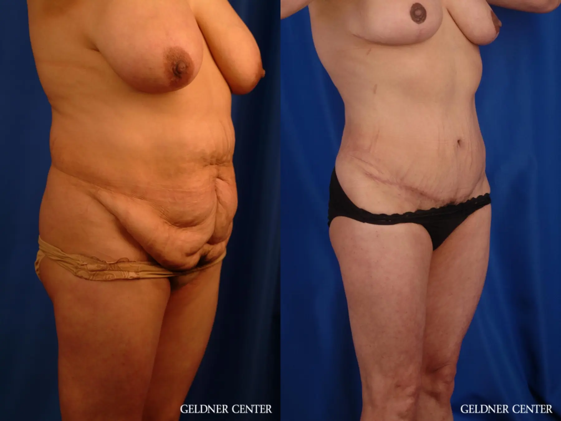 Vaser lipo patient 2629 before and after photos - Before and After 2
