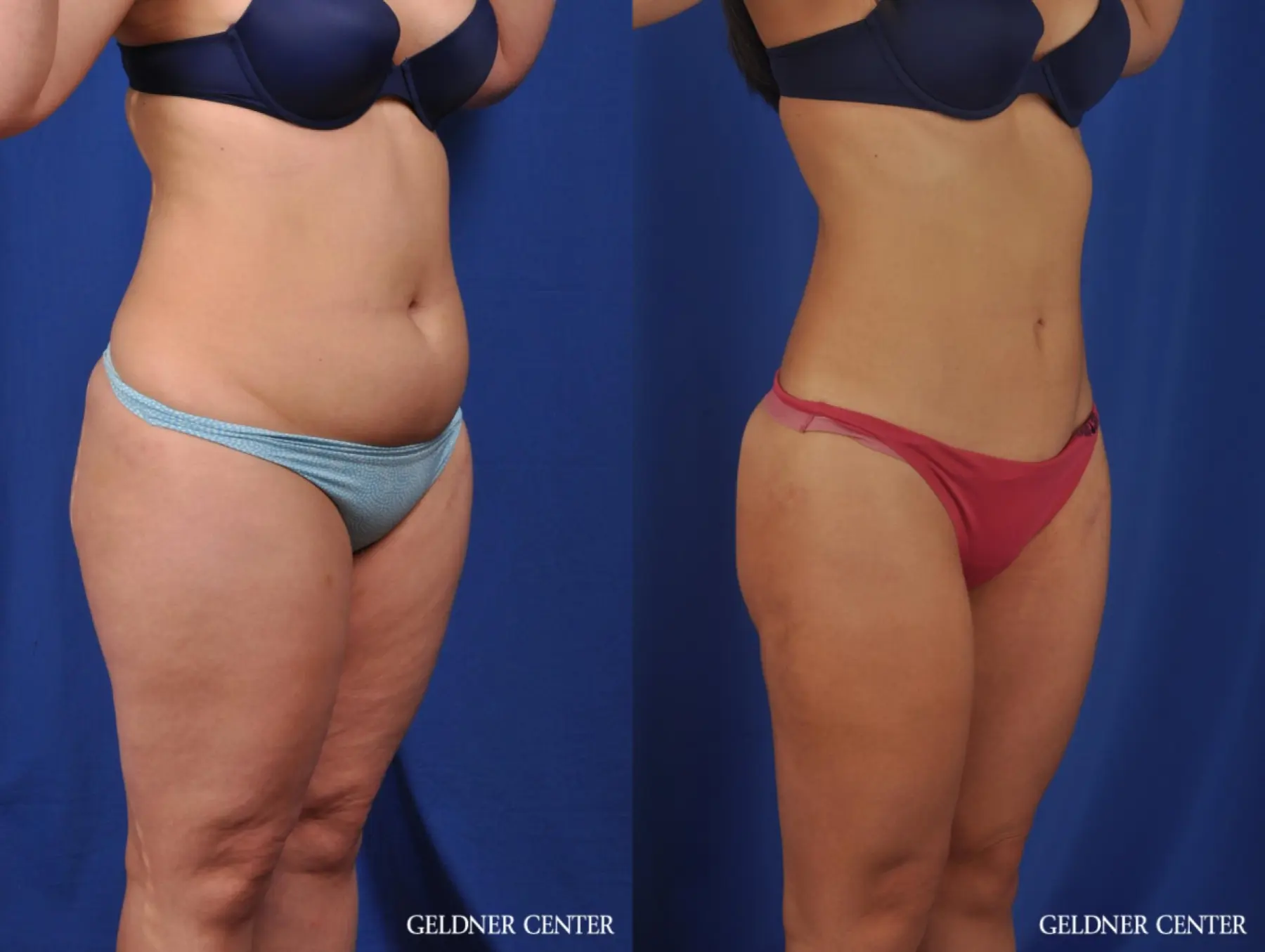 VASER® Lipo: Patient 9 - Before and After 2