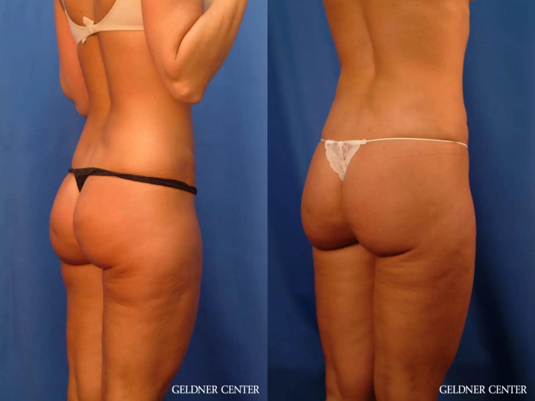 Vaser lipo patient 2624 before and after photos - Before and After 3