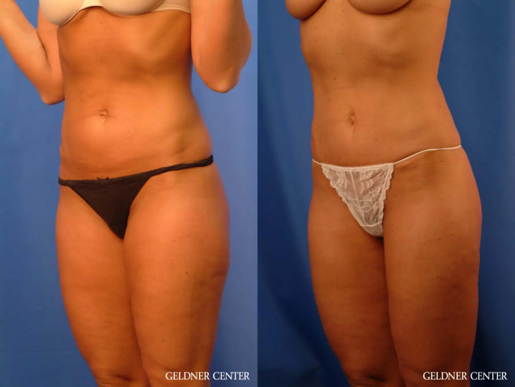 Vaser lipo patient 2624 before and after photos - Before and After 5