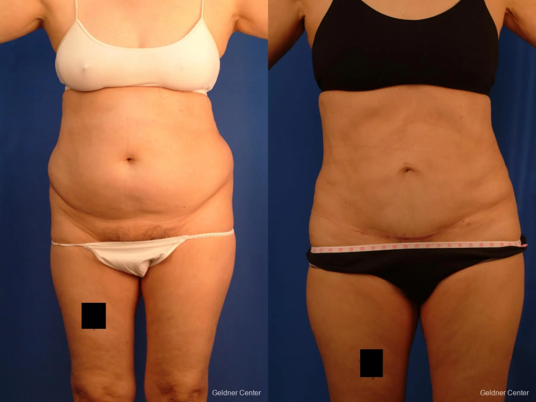Vaser lipo patient 2536 before and after photos - Before and After 1