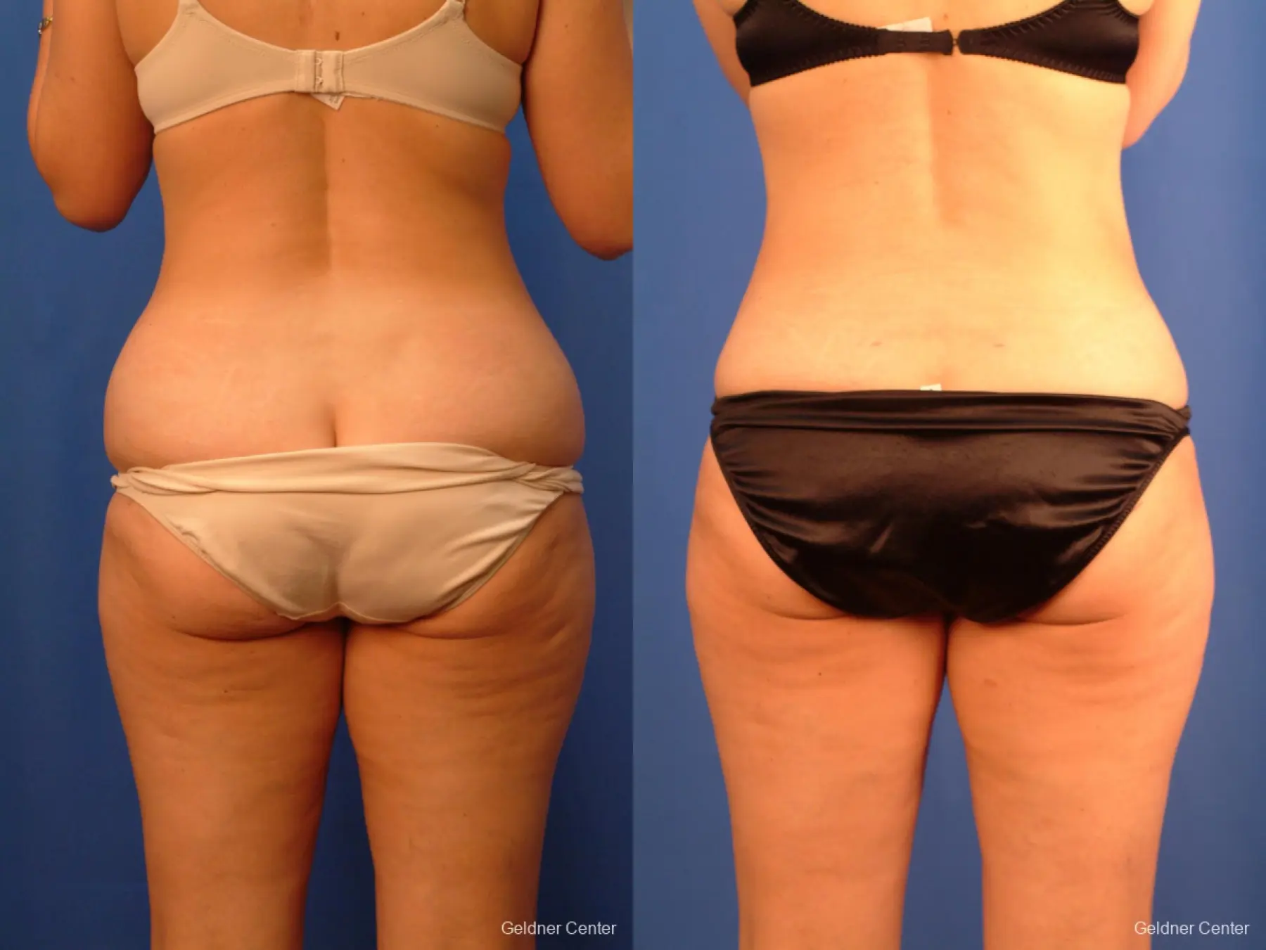 Vaser lipo patient 2520 before and after photos - Before and After 4