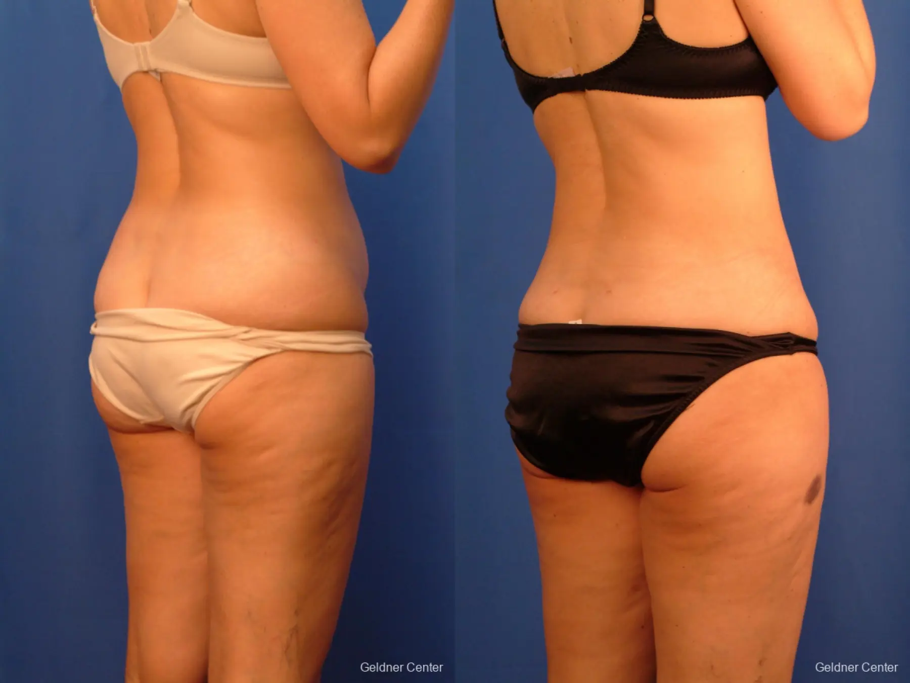 Vaser lipo patient 2520 before and after photos - Before and After 3