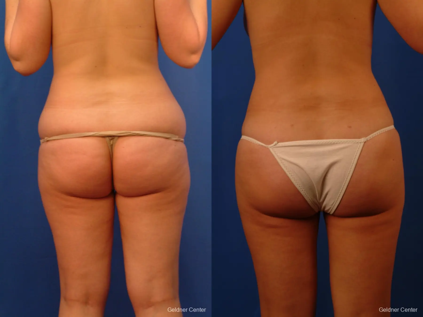 Vaser lipo patient 2516 before and after photos - Before and After 5