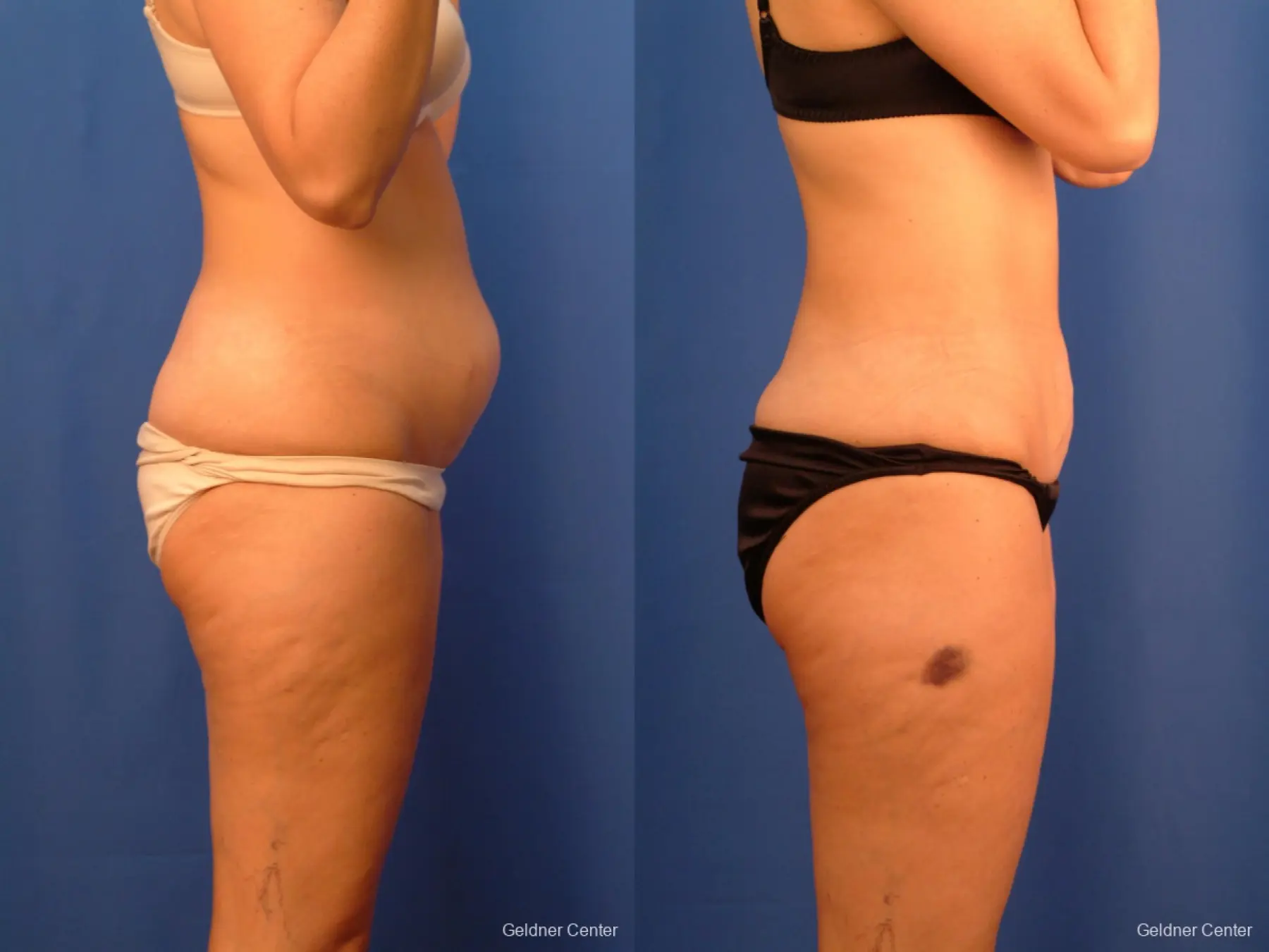 Vaser lipo patient 2520 before and after photos - Before and After 2