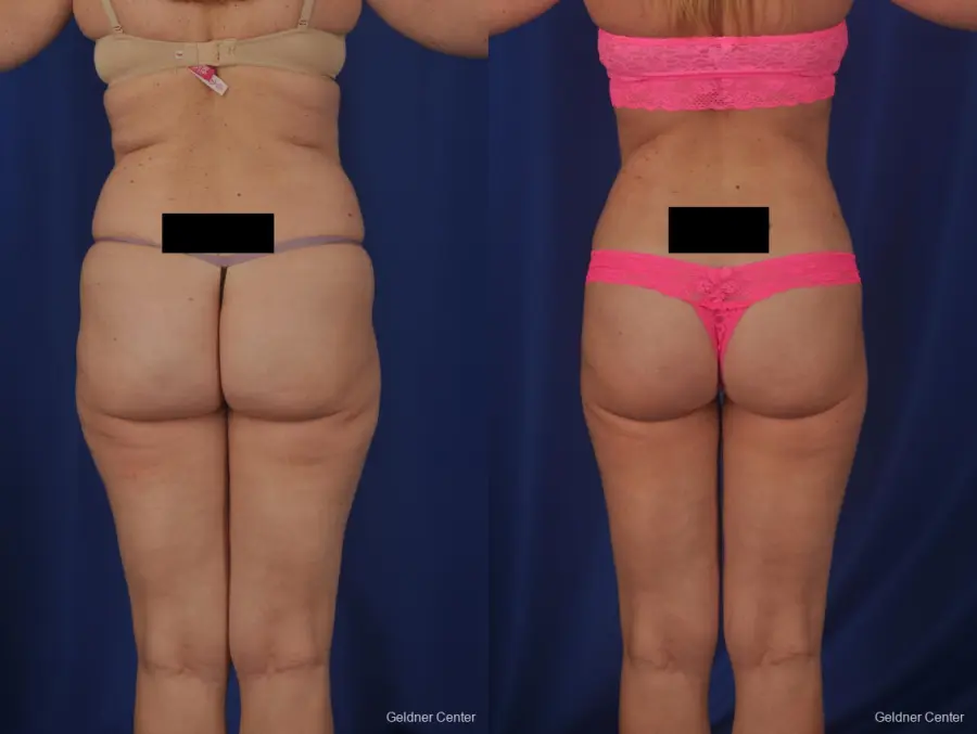Vaser lipo patient 2069 before and after photos - Before and After 3