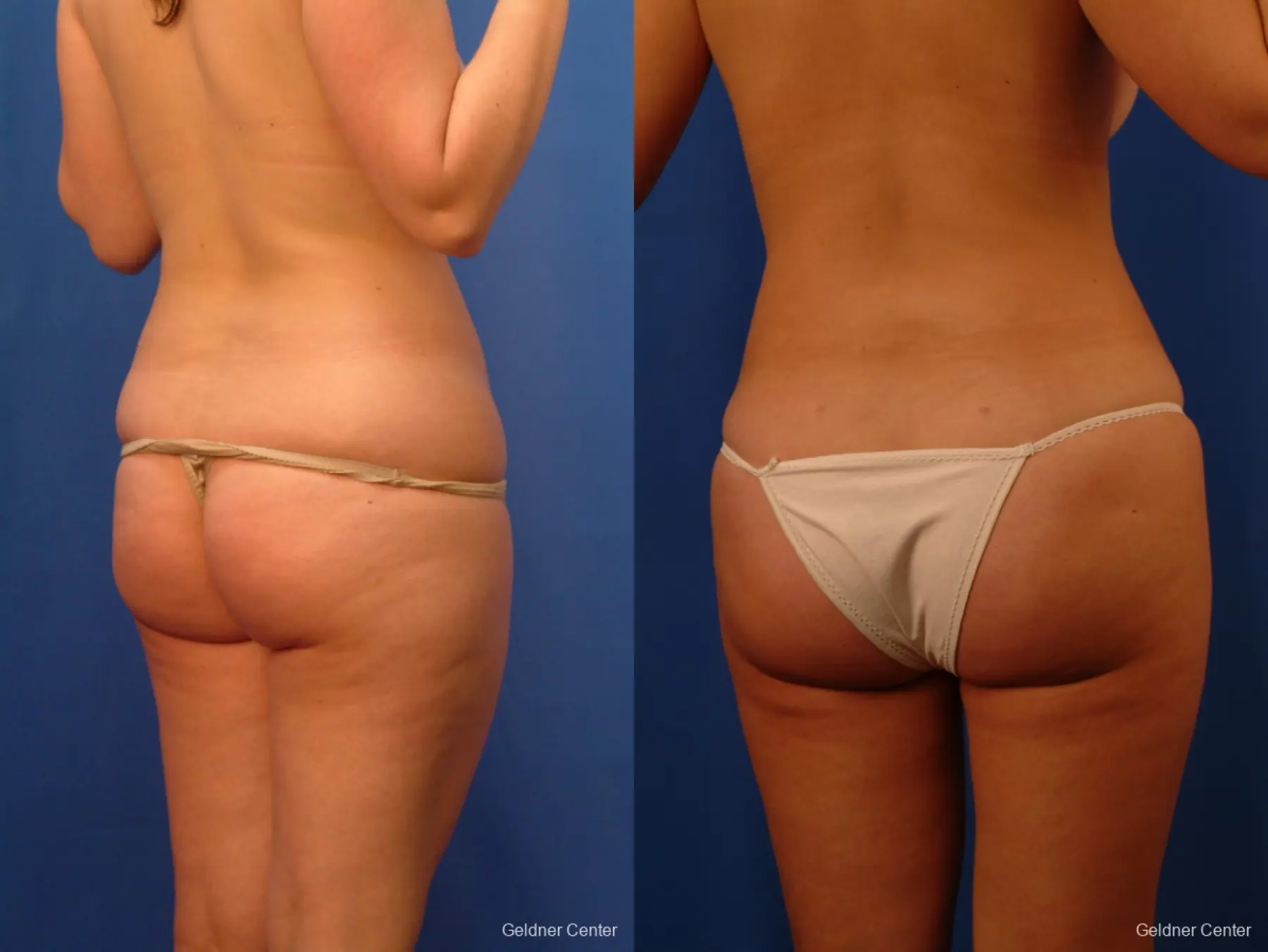 Vaser lipo patient 2516 before and after photos - Before and After 4
