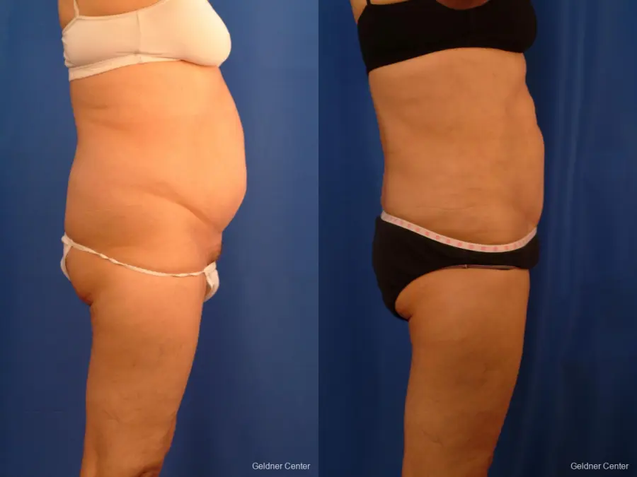 Vaser lipo patient 2536 before and after photos - Before and After 2