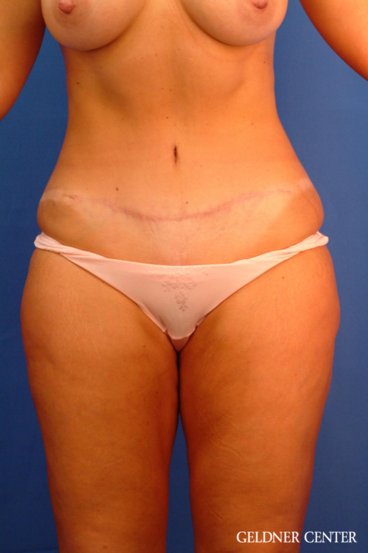 Tummy Tuck: Patient 17 - After 1