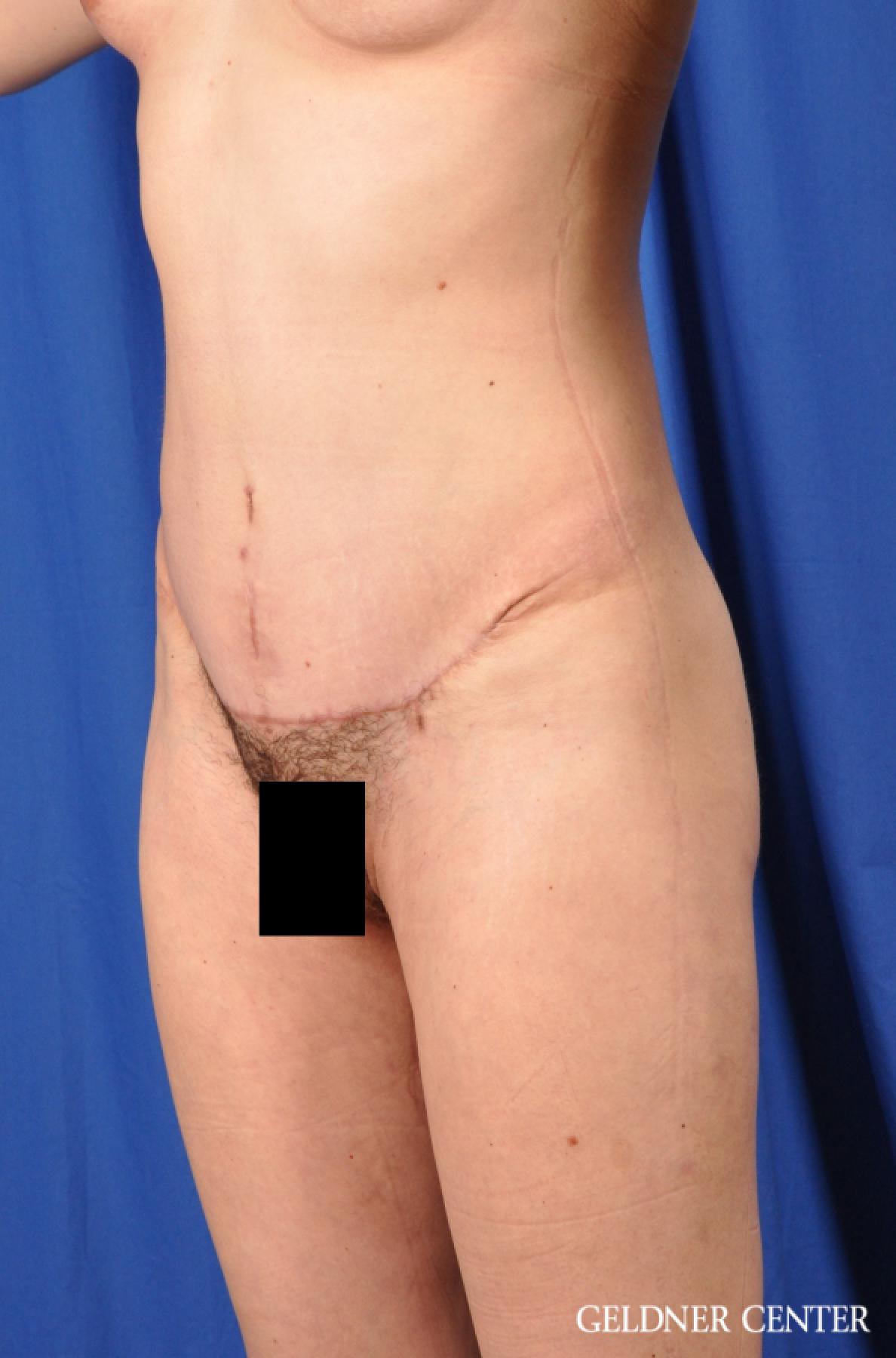 Tummy Tuck: Patient 32 - After 4